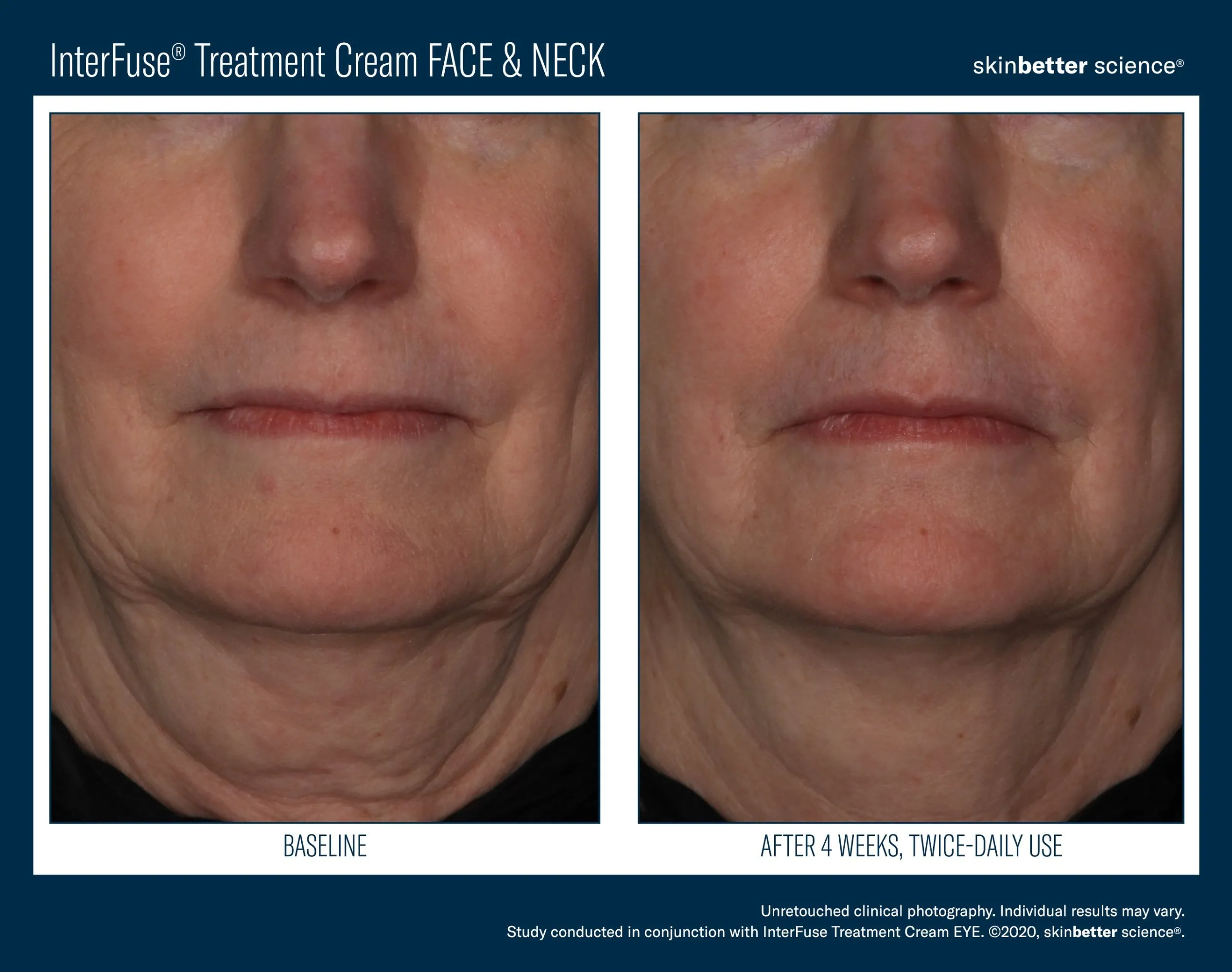 SKINBETTER InterFuse Treatment Face & Neck